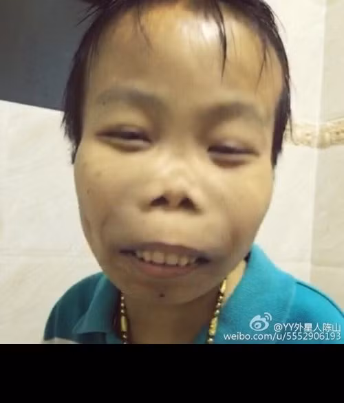 Từ những bằng chứng trên, dân mạng Trung Quốc rút ra kết luận, "đại gia Trần Sơn" chẳng qua chỉ là một "nhân vật ảo" mà một vài các nhân nào đó dựng lên. Kiếm được một anh chàng "xấu lạ", không thể nhận thức được bản thân và những chuyện đang xảy ra, những kẻ này đã khoác lên Lưu Tiểu Hùng một câu chuyện lừa bịp trắng trợn để phục vụ một mục đích cá nhân nào đó đến nay vẫn chưa được làm rõ. Nay "đại gia xấu lạ Trần Sơn" hay Lưu Tiểu Hùng đang sống dở chết dở trên giường bệnh, nhiều dân mạng thể hiện lòng thương cảm trước một số phận bị lợi dụng một cách thể thảm.