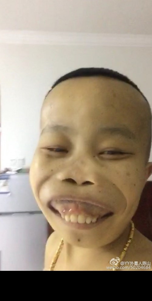 Khi mới nổi tiếng, "đại gia xấu lạ" Trần Sơn được lan truyền là con trai của Trần Dư Hải, tổng giám đốc của Vạn Khoa, một công ty lớn chuyên về vàng bạc ở Trung Quốc. Sinh ra đã mắc một chứng bệnh lạ, dù năm nay 23 tuổi nhưng Trần Sơn lại có thân hình, vóc dáng của một đứa trẻ, ngoài ra khuôn mặt của chàng trai này cũng bị biến dạng rất dị hợm, thậm chí còn bị mô tả là "nửa người nửa ma". Sở dĩ, chàng trai này có khuôn mặt xấu, kỳ dị là do mắc một chứng bệnh tên thalassemia. Người mắc bệnh sẽ không thể làm thay đổi khuôn mặt mình kể cả có can thiệp bằng phẫu thuật thẩm mỹ.