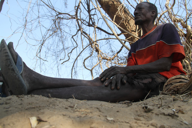 Theo các chuyên gia, người Doma có "truyền thống" chỉ kết hôn trong bộ tộc. Điều này làm tăng khả năng truyền gen ectrodactyly. Ảnh: sundaymail.