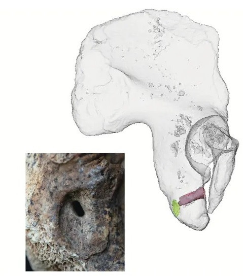 Tác giả đầu tiên của nghiên cứu Michael Francken - bác sĩ chuyên khoa xương tại Văn phòng Nhà nước về Bảo tồn Di tích thuộc Hội đồng Khu vực Stuttgart cho biết kết quả kiểm tra, phân tích bộ hài cốt cho thấy chiến binh Celtic bị thương nặng do trúng tên trong trận chiến cách đây 2.500 năm. Vết thương của chiến binh Celtic đã được chữa lành một phần nhờ điều trị y tế. Ảnh: C. Röding and H. Rathmann / University of Tuebingen.