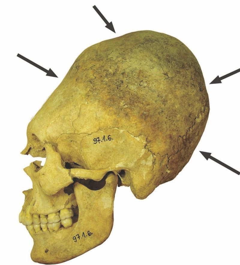 Nhóm chuyên gia cho hay những hộp sọ được kéo dài bằng cách quấn băng trên đầu khi còn là một đứa trẻ. Ảnh: ATI.