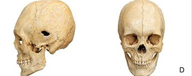 Những bộ hài cốt tìm thấy tại nghĩa trang Mözs-Icsei-dülö cung cấp bằng chứng về những thay đổi đã xảy ra vào thời điểm đó. Ảnh: PLOS ONE.