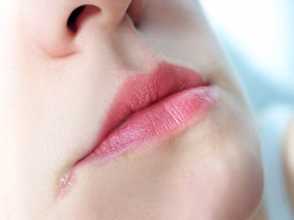 Viêm môi bong vẩy. Bệnh ở miệng này có thể là hệ quả của nứt khóe miệng. Nguyên nhân chủ yếu dẫn đến viêm môi bong vẩy là do cơ thể thiếu nước dẫn đến nứt khóe miệng, khi đó các vi sinh vật và nấm men phát triển, tấn công và gây ra bệnh.