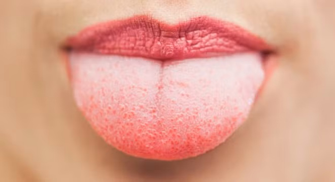 Việc thử thách ăn mì cay cấp độ cao của giới trẻ dường như đang là sự đầu độc sức khỏe của bản thân một cách từ từ. Việc ăn mì cay quá nhiều hoặc ở những cấp độ cao, lưỡi sẽ bị bỏng, rát, thậm chí có thể gây lở miệng. Bên cạnh đó, chất Capsaicin trong ớt không thể tiêu hóa được nên sẽ gây cảm giác nóng, rát ở hậu môn khi đại tiện.