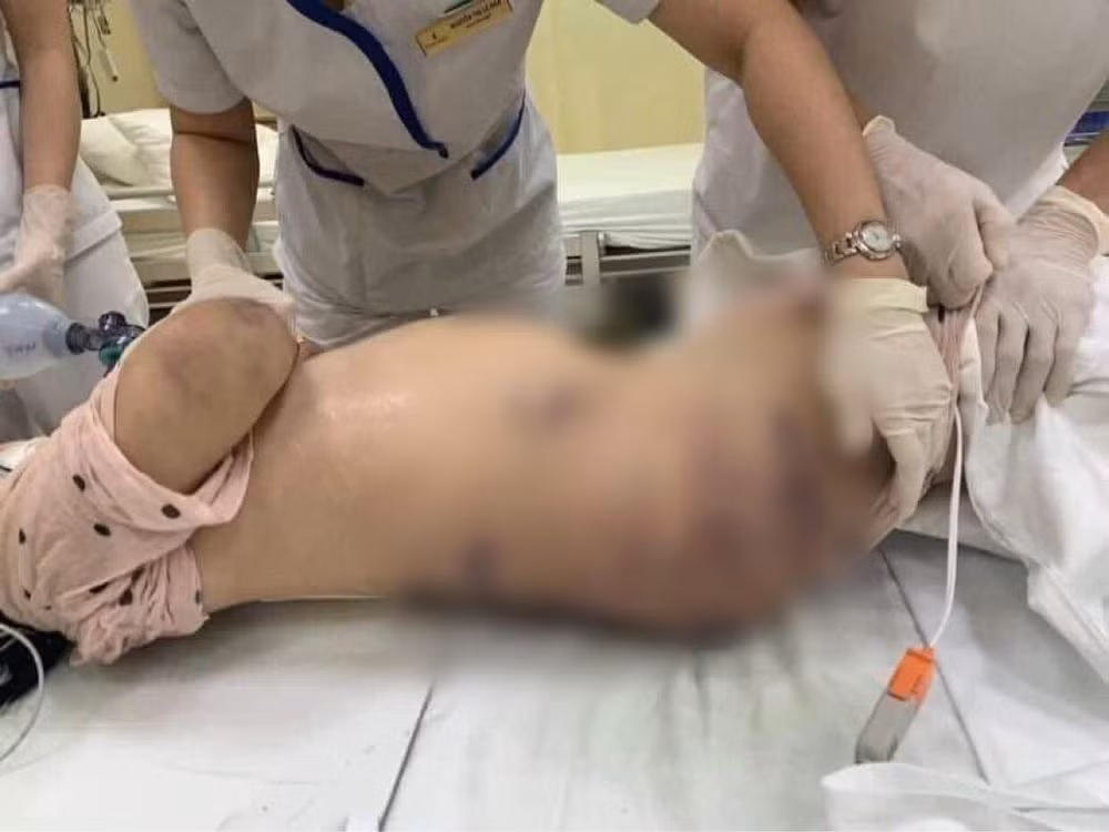 Theo kết luận giám định pháp y tử thi của Phòng kỹ thuật hình sự Công an TP HCM, cháu A. tử vong do phù phổi cấp do sốc chấn thương. Ngay sau đó, cơ quan điều tra đã lần lượt khởi tố, bắt tạm giam Trang và Thái do có liên quan đến cái chết của bé V.A.