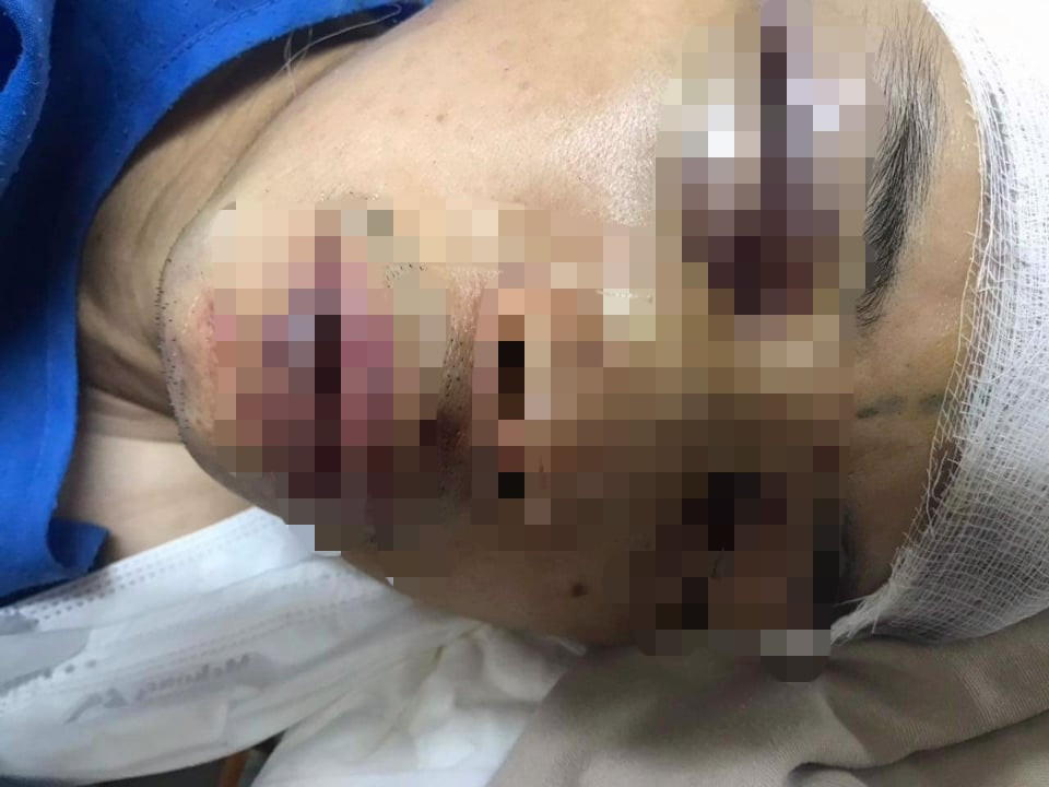 Khoảng hơn 21h cùng ngày, khi cán bộ công an đang bàn chuẩn bị lực lượng phối hợp cùng chính quyền canh giữ để tránh việc công ty san lấp thì việc san lấp diễn ra. Lúc này, ông Hanh và ông Tuấn Anh đứng ra ngăn chặn thì bị nhóm người đánh đập dã man. Ông Hanh bị đánh nứt hộp sọ, gãy răng, hiện đang điều trị tại bệnh viện Việt Đức. Ông Tuấn Anh bị đánh vào đầu, ngực. 