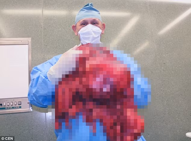 Di kham dau lung, phat hien khoi u 25kg trong bung-Hinh-2