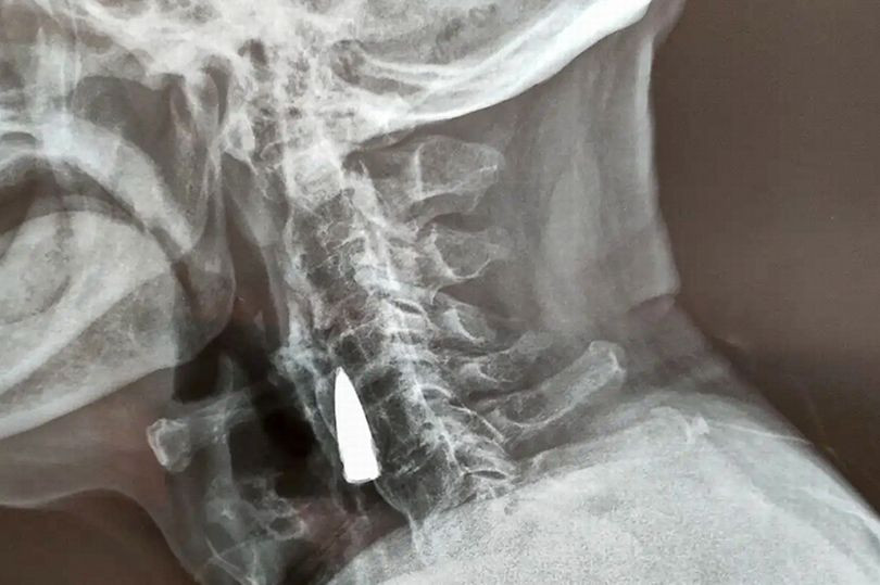 Phat hien vien dan gam trong co cuu chien binh suot 77 nam