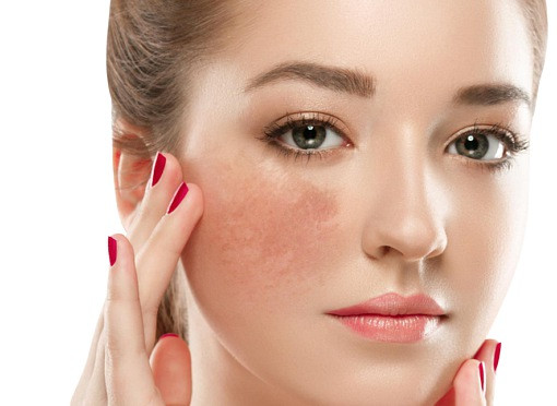 Thanh thiếu niên thường bị mụn trên mặt, sau khi uống thuốc và bôi thuốc, mụn có thể khỏi, thế nhưng nếu trên mặt bệnh nhân có những nốt thâm đen to, không đều thì nên hỏi ý kiến bác sĩ về vấn đề đường tiêu hóa ngay.