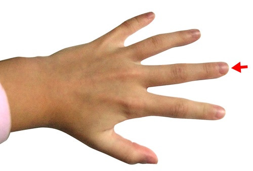 Thậm chí, nếu ngón giữa xuất hiện các nốt đỏ, chứng tỏ lòng bàn tay cũng có thể có những nốt đỏ rõ ràng hơn, hiện tượng này còn được gọi là gan bàn tay, đừng bỏ qua nó, hãy đi kiểm tra gan ngay để kịp thời phát hiện các vấn đề sức khoẻ và chữa trị sớm.