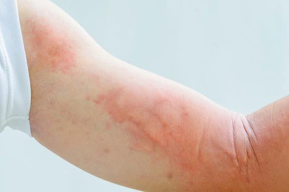 Nếu da khô ngứa, ngoài việc tránh gãi thì cũng nên tránh những hành vi giảm ngứa bằng nước đá, cách tốt nhất để cải thiện cảm giác ngứa một cách hiệu quả nhờ đến sự hỗ trợ của bác sĩ.