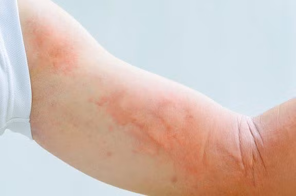 Nếu da khô ngứa, ngoài việc tránh gãi thì cũng nên tránh những hành vi giảm ngứa bằng nước đá, cách tốt nhất để cải thiện cảm giác ngứa một cách hiệu quả nhờ đến sự hỗ trợ của bác sĩ.