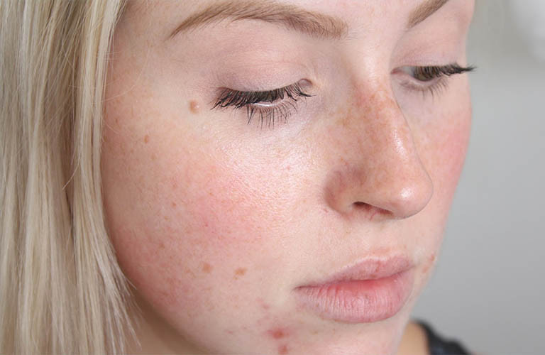 Vì vậy, đừng nghĩ rằng tế bào ung thư vẫn còn ở xa, nếu như ung thư đang dần xâm lấn vào cơ thể thì đa số đều sẽ có 3 đặc điểm này, các bác sĩ còn gọi 3 đặc điểm này là "bộ mặt ung thư". Đừng cậy mình còn trẻ mà coi thường các dấu hiệu cơ thể cảnh báo.