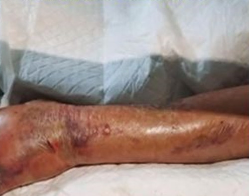 An tom khong chu y, nguoi dan ong phai cat cut ca canh tay