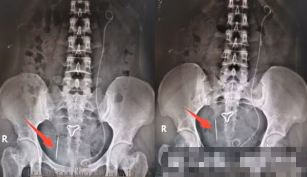 Tưởng sỏi thận, ai ngờ cơ thể giấu thứ ghê rợn này 20 năm Tuong soi than, ai ngo co the giau thu ghe ron nay 20 nam