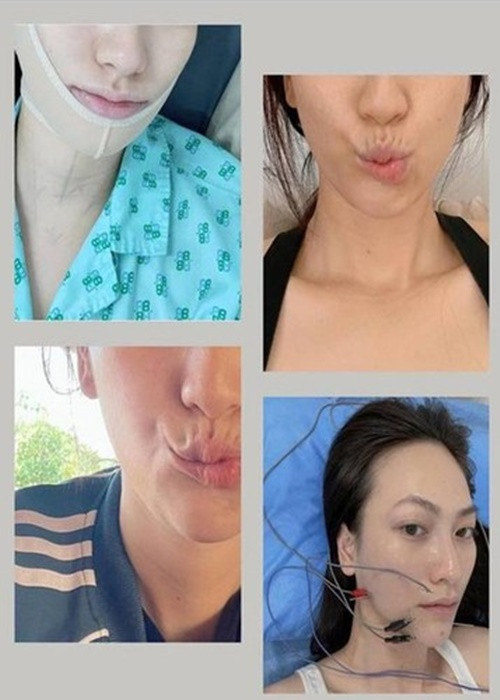 Nữ chính phim “Vô diện sát nhân” phát hiện mắc bệnh u tuyến giáp vào năm 2020. Tháng 4/2021, cô nhập viện để phẫu thuật. Sau ca mổ, nữ diễn viên bị lệch khung môi mỗi khi vận động. Một tháng sau ca mổ, sức khỏe của Phương Anh Đào bắt đầu cải thiện. Ảnh: FBNV