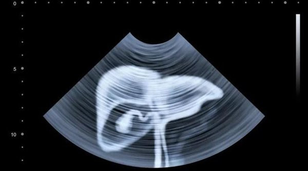 Chuyen gia chi diem 5 kieu nguoi de ung thu gan, ban co trong so do?