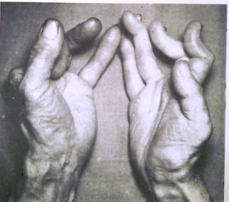 Chẳng mấy chốc, cả hai bàn tay của Dally đều bị bỏng liên tục, anh phải ngâm chúng trong nước qua đêm để có thể ngủ ngon giấc. Một vài năm sau, các bác sĩ đã cố gắng ghép da từ chân của Dally sang bàn tay trái đang dần phân hủy của anh nhưng nó không có tác dụng.