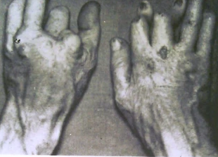 Cuối cùng, mọi thứ trở nên rõ ràng rằng đó không chỉ là những tổn thương ở tay, mà là ung thư biểu mô, ung thư da mà ngày nay chúng ta biết. Đây là việc gần như không thể tránh khỏi những liều phóng xạ lớn và liên tục anh đã chịu đựng.