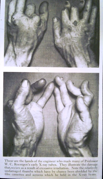 Vì bàn tay trái quá yếu nên Dally đã sử dụng bàn tay phải khỏe mạnh hơn để tiếp tục làm thí nghiệm.