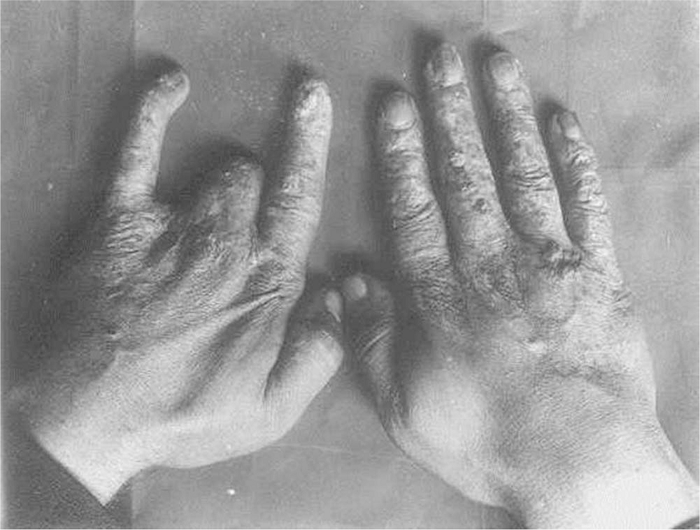 Sau đó, Dally đã phải cắt cụt cánh tay trái. Và vài tháng sau, bốn ngón tay phải của anh cũng phải cắt bỏ. Vì vậy, Dally không còn có thể làm việc trong phòng thí nghiệm của Edison, nhưng anh hứa sẽ hỗ trợ ông đến hết cuộc đời. Năm 1903, cánh tay phải của Dally cũng bị cắt cụt. Một năm sau, anh đã chết vì ung thư da di căn ở tuổi 39, tám năm kể từ lần đầu tiên anh bị thu hút bởi hình ảnh X-quang.