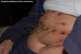 Tuy nhiên khoảng một tháng sau chúng lại bắt đầu xuất hiện và không những không rụng đi mà còn dần dần lớn hơn. Hiện tượng này được nhiều nhà khoa học cũng như các bác sĩ đặc biệt quan tâm nhưng vẫn không thể nào tìm ra được lời giải thích.