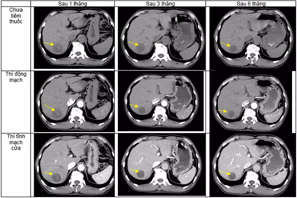 Ha Noi: Nam benh nhan mac 2 benh ung thu ha hong va gan