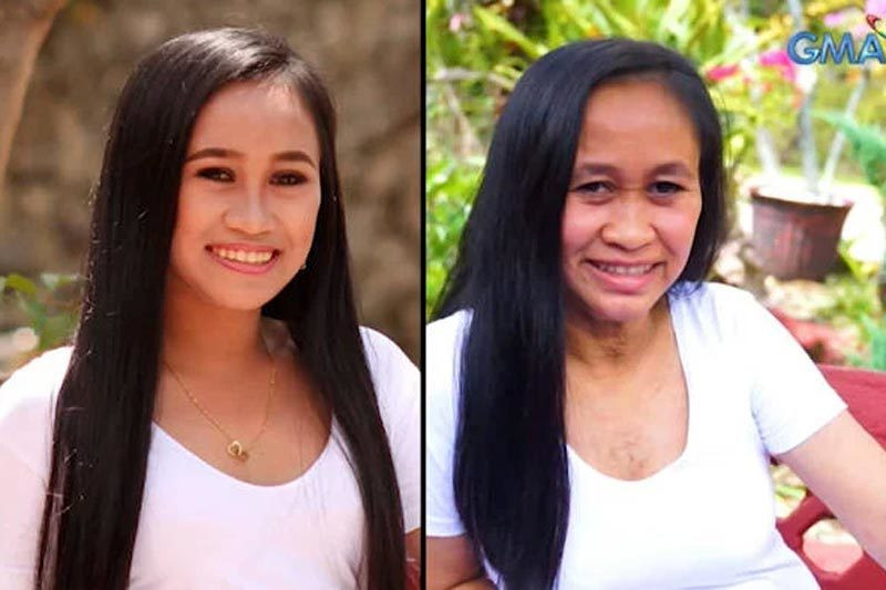 Chỉ trong vòng 2 năm, hội chứng Progeria, còn được gọi là bệnh "già sớm", đã biến Raizel Calago, người Phillipines, từ một thiếu nữ xinh tươi, trở thành một bà lão. Ảnh: GMA.