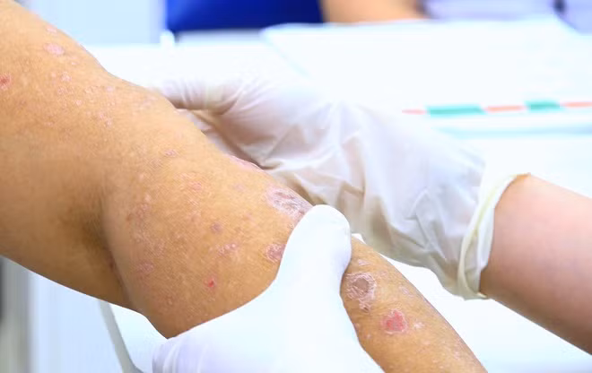 Stress vì mất việc mùa dịch, nhiều người TPHCM “mọc vảy” khắp cơ thể Stress vi mat viec mua dich, nhieu nguoi TPHCM “moc vay” khap co the