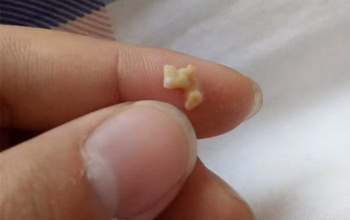 Hơi thở con có mùi, mẹ đưa đi khám...gắp ra hạt đáng sợ - Hình 2 Hoi tho con co mui, me dua di kham...gap ra hat dang so-Hinh-2