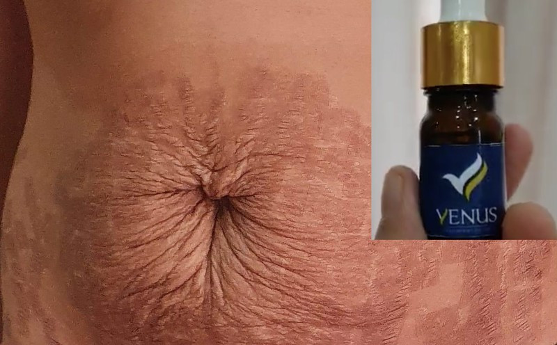 Thẩm mỹ viện quốc tế Venus bị phạt 85 triệu, đóng cửa 9 tháng Tham my vien quoc te Venus bi phat 85 trieu, dong cua 9 thang