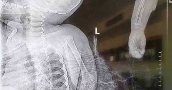 Trong ảnh là phim chụp X-quang cánh tay của bé trai bị chó ngao Tây Tạng cắn đứt lìa.