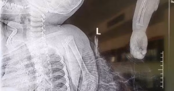 Trong ảnh là phim chụp X-quang cánh tay của bé trai bị chó ngao Tây Tạng cắn đứt lìa.