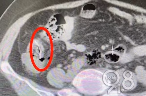 Cố nuốt xương cá khi hóc, người phụ nữ thủng ruột suýt chết Co nuot xuong ca khi hoc, nguoi phu nu thung ruot suyt chet