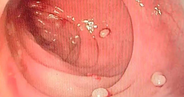 Noi soi phat hien 20 vien “ngoc trai”...ket dau long