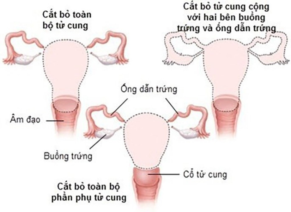 Các tình huống phải cắt bỏ tử cung