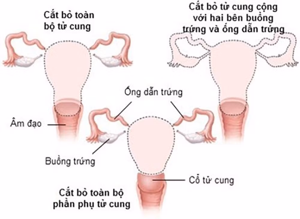 Các tình huống phải cắt bỏ tử cung