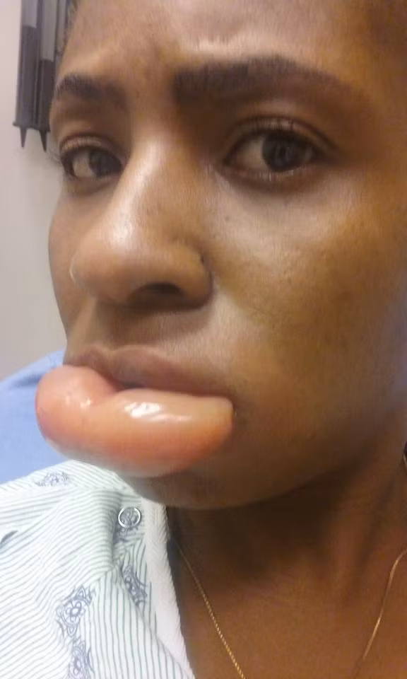 Randy Schueller, một chuyên gia về hóa mỹ phẩm nhận định, trường hợp này có thể do người dùng dị ứng với một số thành phần nào đó của son môi - sản phẩm của CoverGirl Queen Collection dù nhãn mác cho thấy không có thành phần nào đáng lưu ý. Sản phẩm này có mùi thơm và có thể bệnh nhân bị dị ứng với chất tạo mùi. Tuy nhiên chuyên gia này cũng lưu ý, CoverGirl là một thương hiệu mỹ phẩm lớn nên khó có trường hợp các chuyên gia bất cẩn trong một khâu nào đó. 