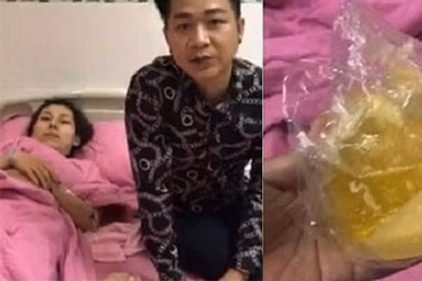  Nổ túi ngực như Ivy Trần có lẽ không còn là chuyện hiếm đối với những người phẫu thuật thẩm mỹ nâng ngực. Biến chứng luôn rình rập, và đôi khi hậu quả vô cùng khủng khiếp.