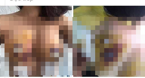 Một phụ nữ tại Hà Nội bỏ ra gần 300 triệu đồng để nâng ngực, nâng mũi tại một BV thẩm mỹ, ít ngày sau ngực chị có dấu hiệu bầm dập sưng tấy bất thường, vết mổ chảy máu, toét ra.