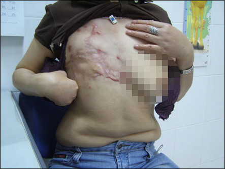 Một trường hợp phải cắt bỏ hoàn toàn một bên ngực do biến chứng quá nặng nề.