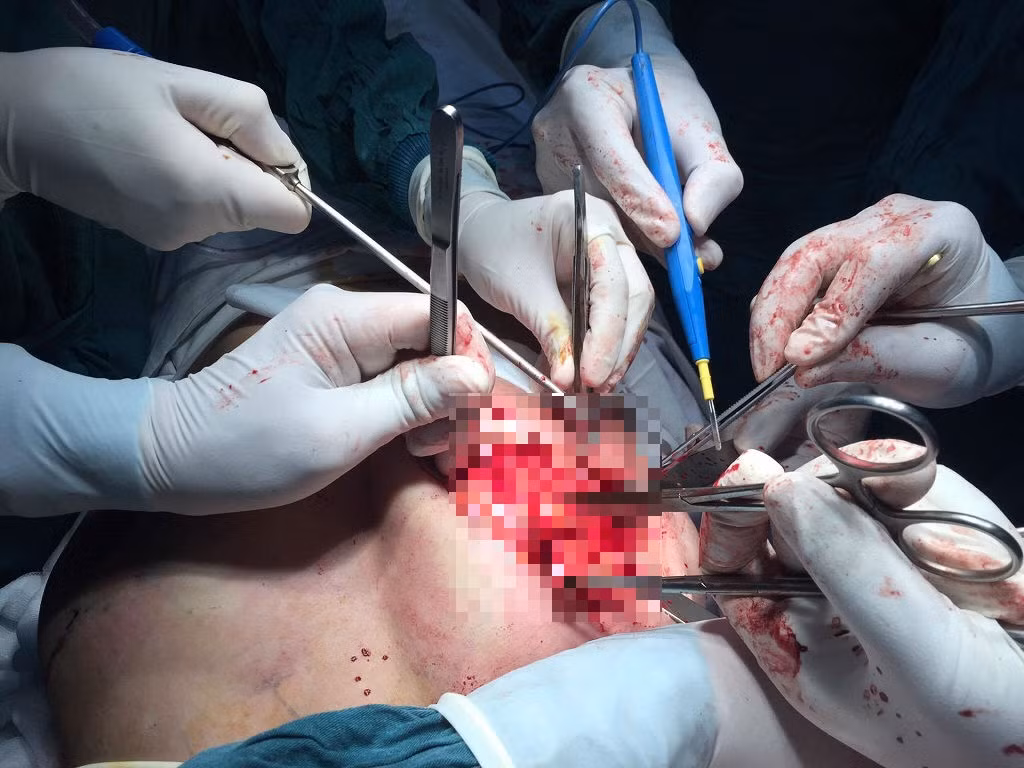 Nhiều trường hợp biến chứng nặng nề, người bệnh thậm chí phải tái phẫu thuật nhiều lần để xử lý.