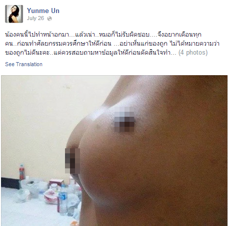 Hình ảnh bộ ngực bị biến dạng của cô gái Thái sau khi phẫu thuật thẩm mỹ hỏng.