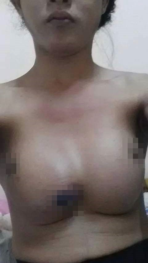 Một cô gái Thái đã đăng những bức ảnh cho thấy vòng 1 của cô bị biến dạng, và gần như dính liền với nhau.