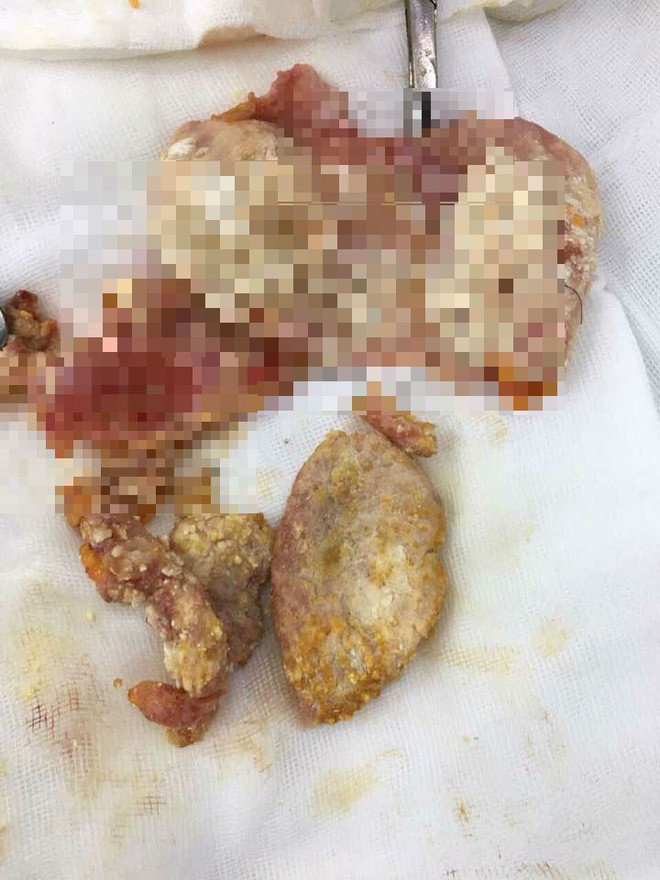 Đây là những gì còn lại của bầu ngực đẹp đẽ sau 20 năm đặt túi nâng ngực. Túi ngực bị vỡ, tiết dịch, vôi hóa và co cứng, biến dạng như một khối cao su đặc có mặt ngoài rất nhiều cục nhỏ lợn cợn.