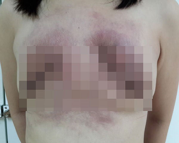 Biến chứng sau phẫu thuật nâng ngực sớm là biến chứng trong tháng đầu sau phẫu thuật, bao gồm: tụ máu, nhiễm trùng, toác vết mổ.