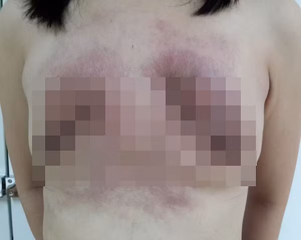 Biến chứng sau phẫu thuật nâng ngực sớm là biến chứng trong tháng đầu sau phẫu thuật, bao gồm: tụ máu, nhiễm trùng, toác vết mổ.