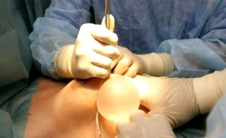 Ngoài tình trạng vón cục, silicon trong túi ngực vỡ ra có thể chảy vào 2 khoang ngực, thậm chí xuống vùng bụng, nếu không can thiệp sớm, những biến chứng nguy hiểm có thể đe dọa tính mạng người bệnh.