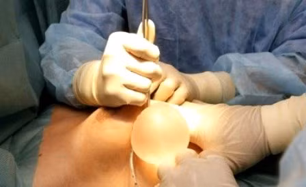 Ngoài tình trạng vón cục, silicon trong túi ngực vỡ ra có thể chảy vào 2 khoang ngực, thậm chí xuống vùng bụng, nếu không can thiệp sớm, những biến chứng nguy hiểm có thể đe dọa tính mạng người bệnh.