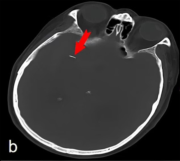 Nguoi dan ong co chiec kim trong nao suot 20 nam ma khong biet